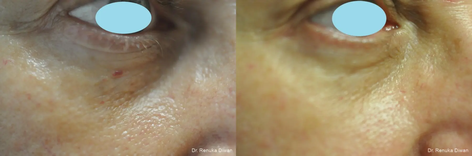 Laser For Veins And Redness: Patient 31 - Before and After 1