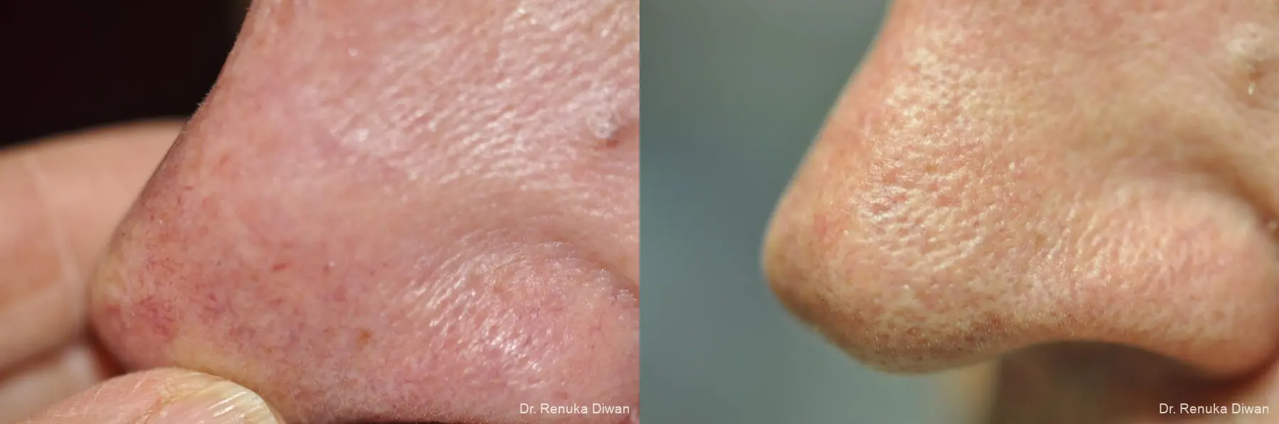 Laser For Veins And Redness: Patient 23 - Before and After 1