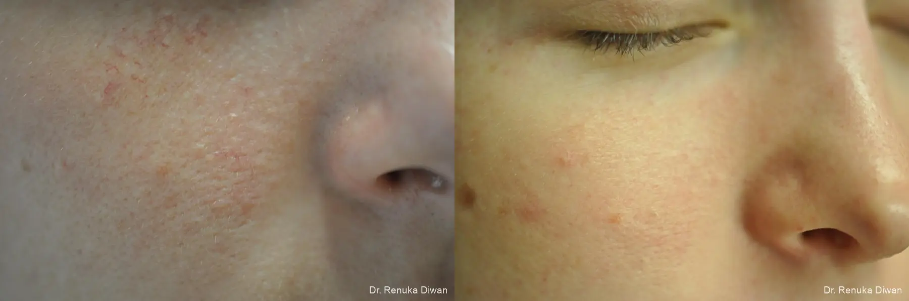 Laser For Veins And Redness: Patient 27 - Before and After 1