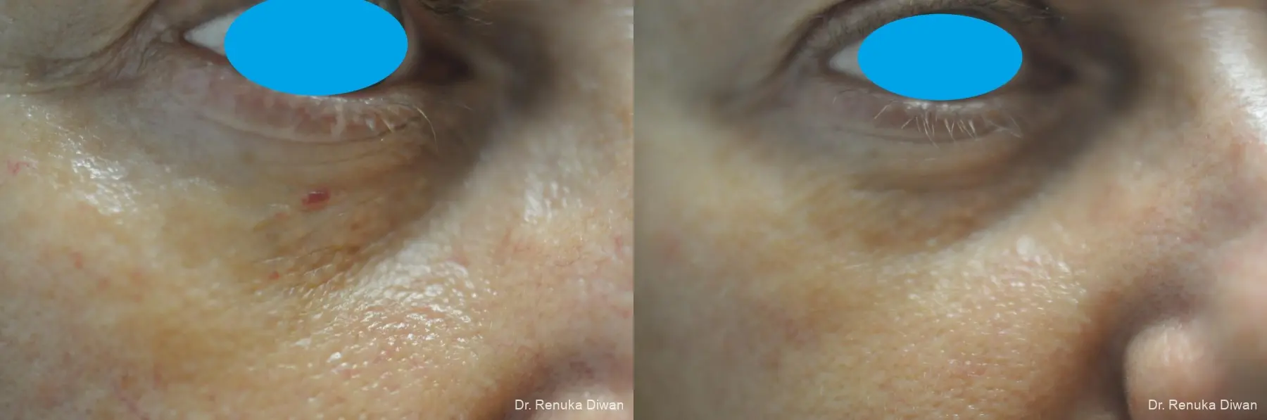 Laser For Veins And Redness: Patient 35 - Before and After 2