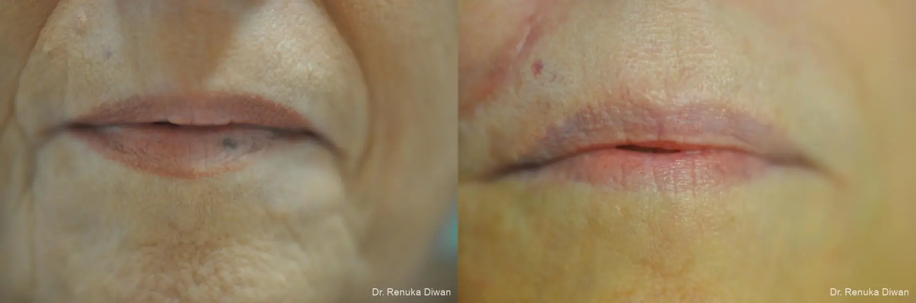 Laser For Veins And Redness: Patient 36 - Before and After 1