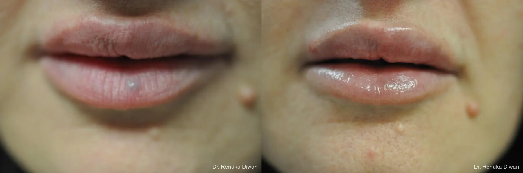 Laser For Veins And Redness: Patient 33 - Before and After 1