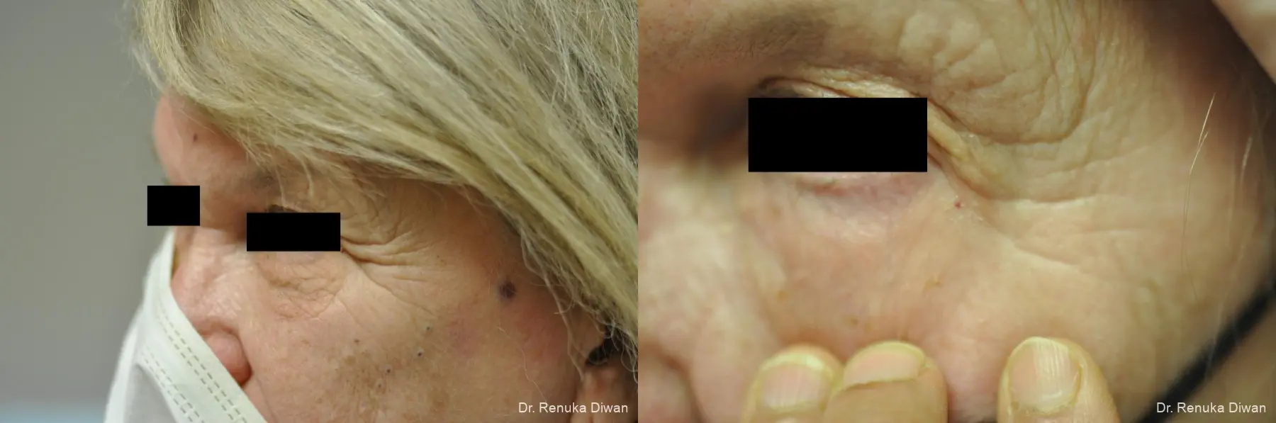 Laser For Veins And Redness: Patient 25 - Before and After 3