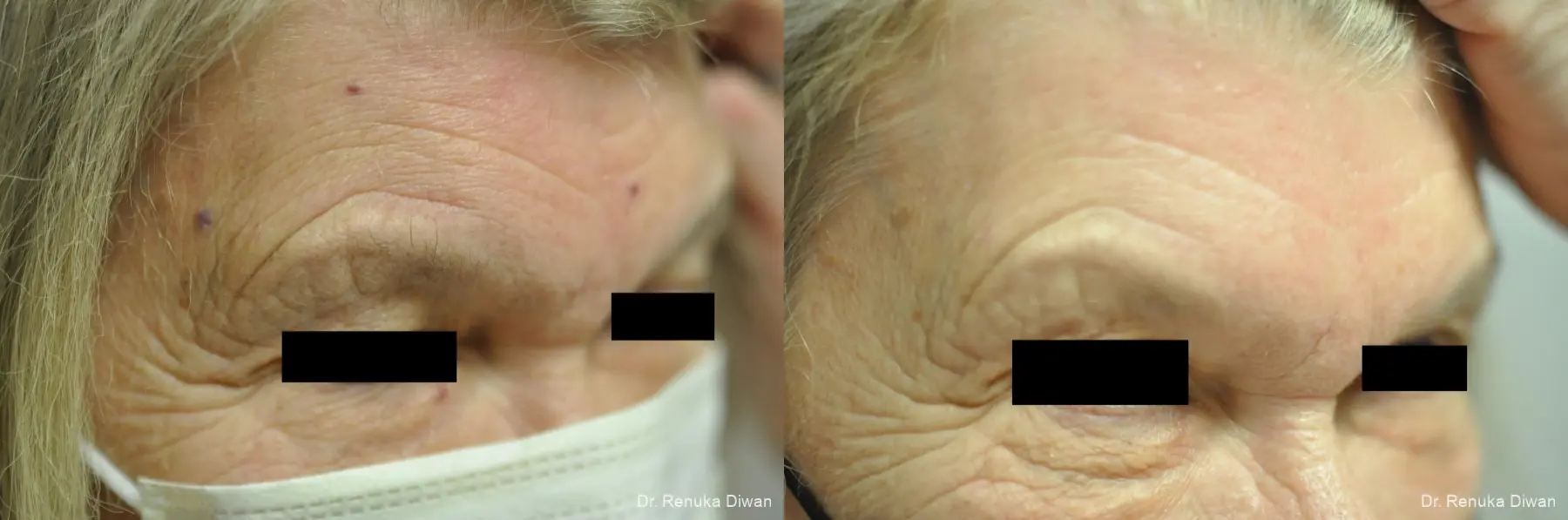 Laser For Veins And Redness: Patient 25 - Before and After 1