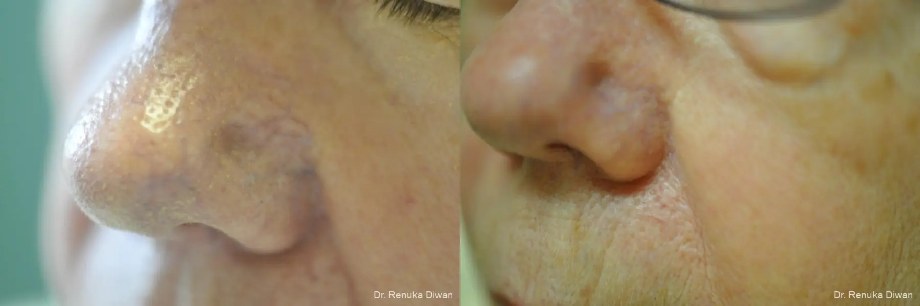 Laser For Veins And Redness: Patient 32 - Before and After 1