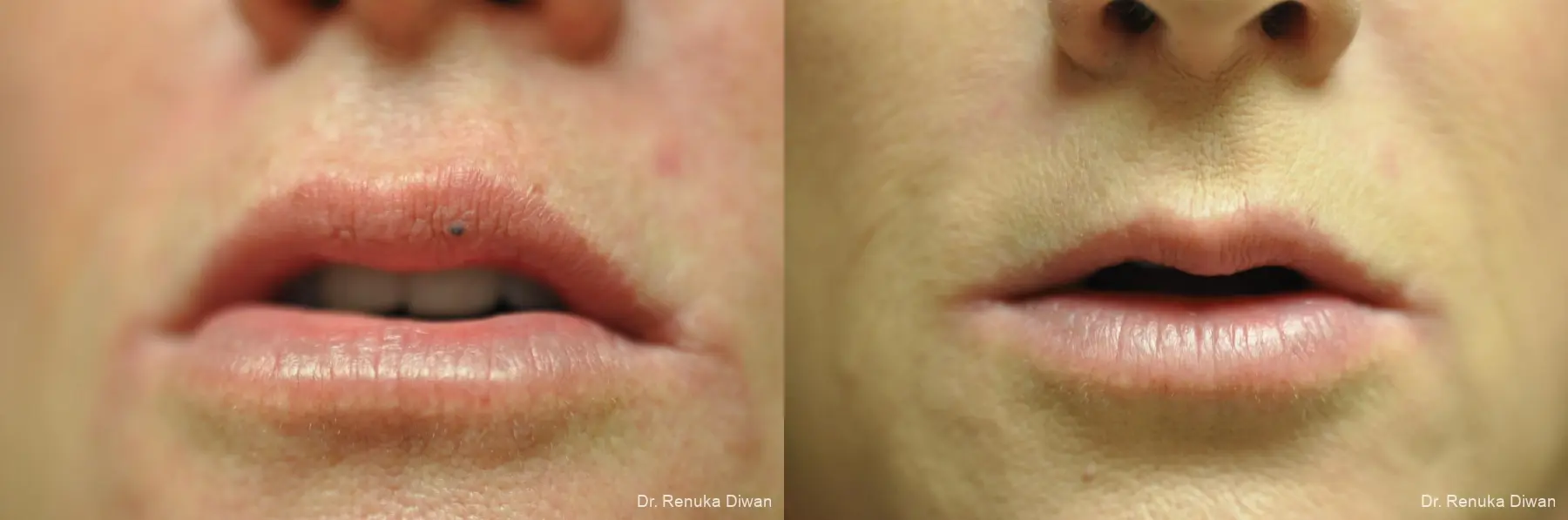 Laser For Veins And Redness: Patient 29 - Before and After 1