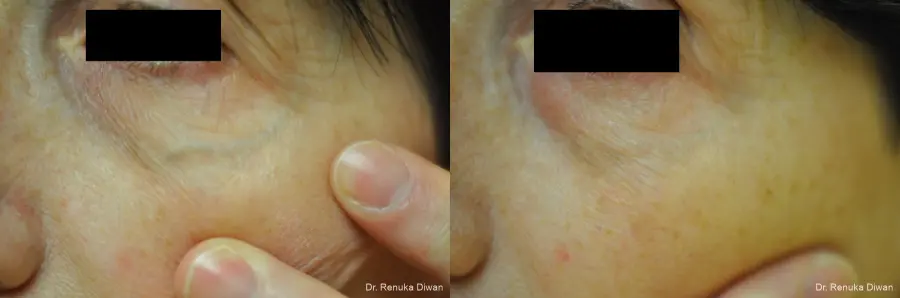 Laser For Veins And Redness: Patient 12 - Before and After 1