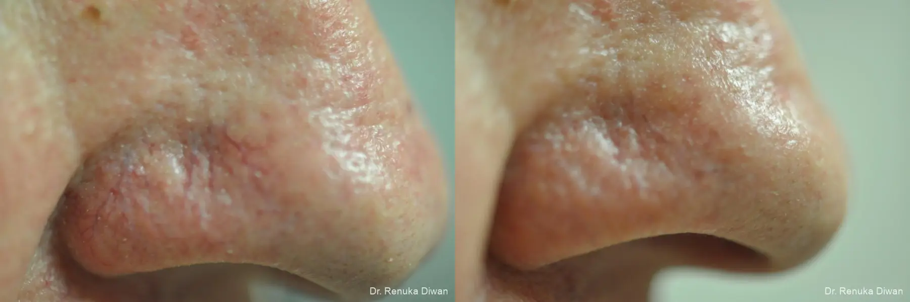 Laser For Veins And Redness: Patient 34 - Before and After 1
