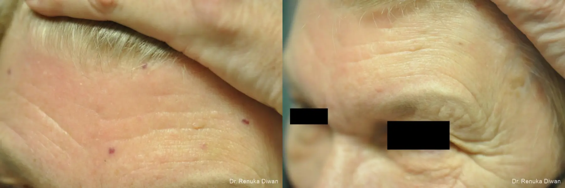 Laser For Veins And Redness: Patient 23 - Before and After 2