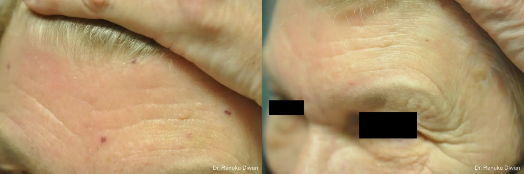 Laser For Veins And Redness: Patient 25 - Before and After 2