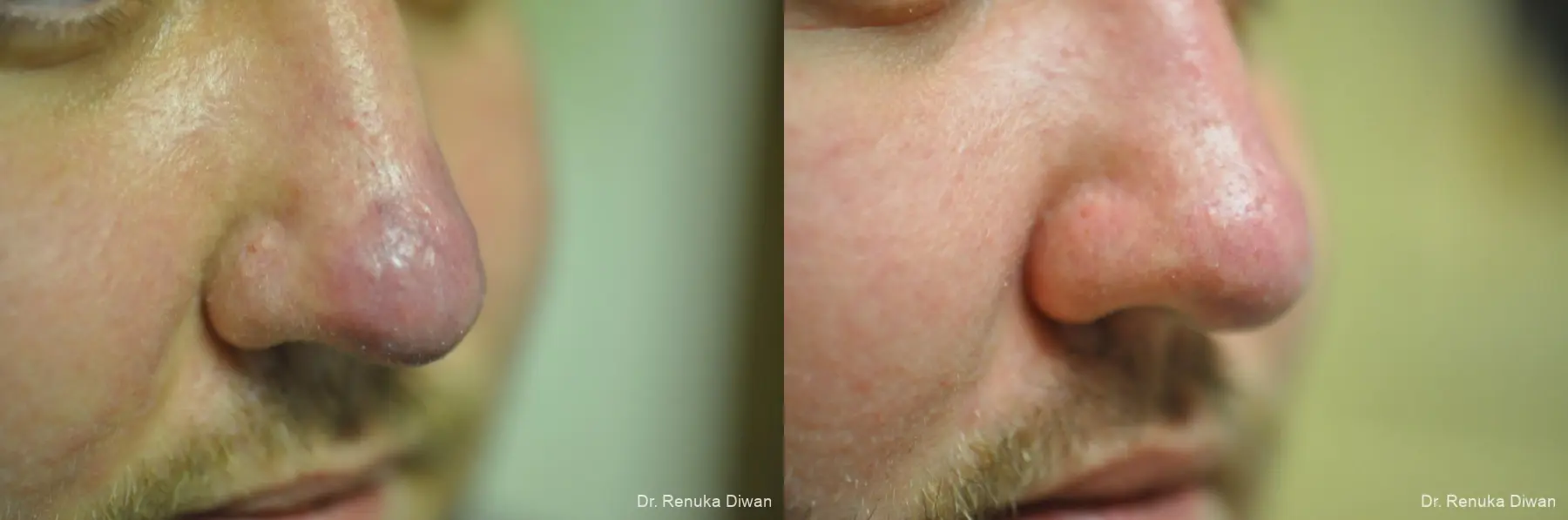 Laser For Veins And Redness For Men: Patient 9 - Before and After 1