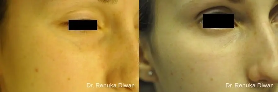 Laser For Veins And Redness: Patient 25 - Before and After 1