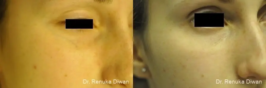 Laser For Veins And Redness: Patient 26 - Before and After 1