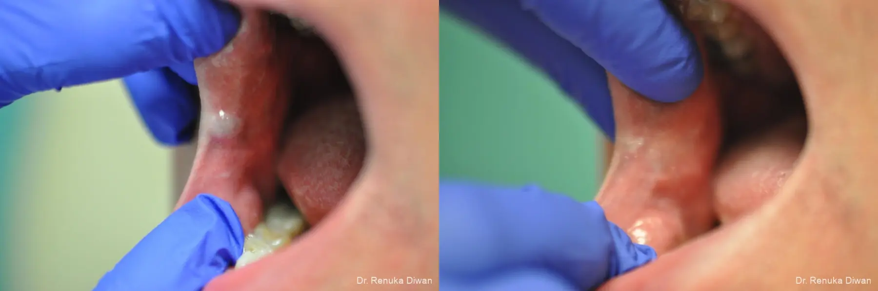 Laser For Veins And Redness: Patient 24 - Before and After 1