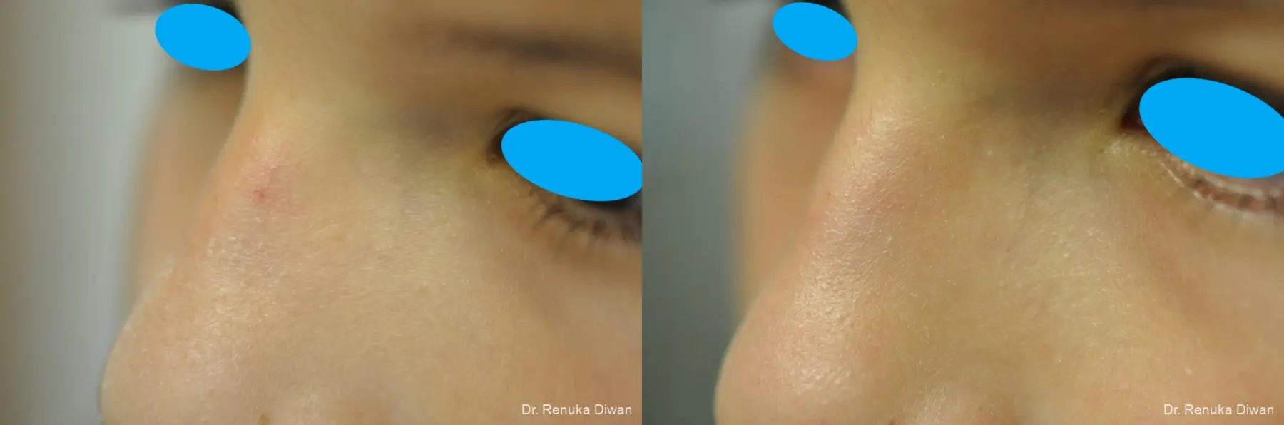 Laser For Veins And Redness: Patient 30 - Before and After 1