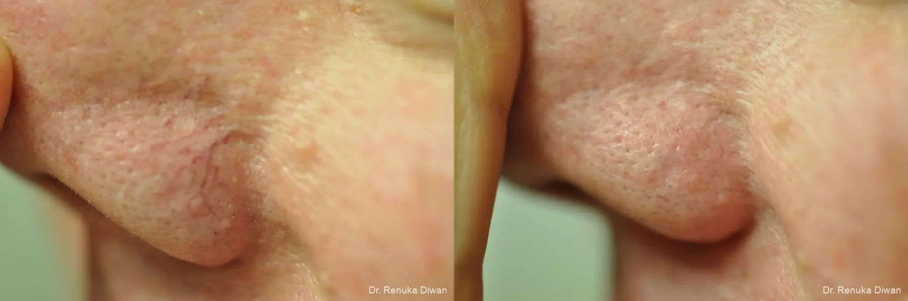 Laser For Veins And Redness: Patient 22 - Before and After 1