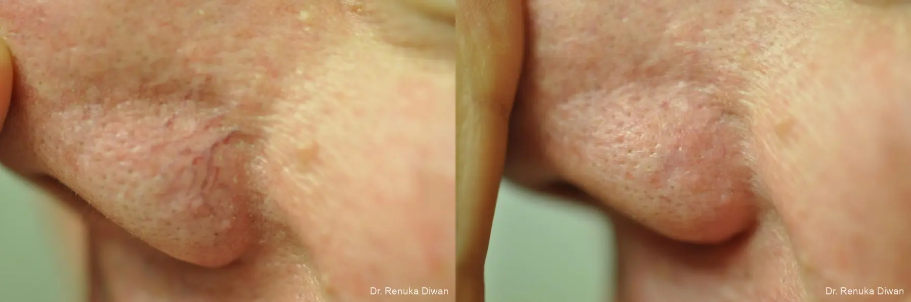 Laser For Veins And Redness: Patient 23 - Before and After 1