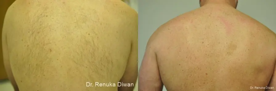 Laser Hair Removal: Patient 2 - Before and After  