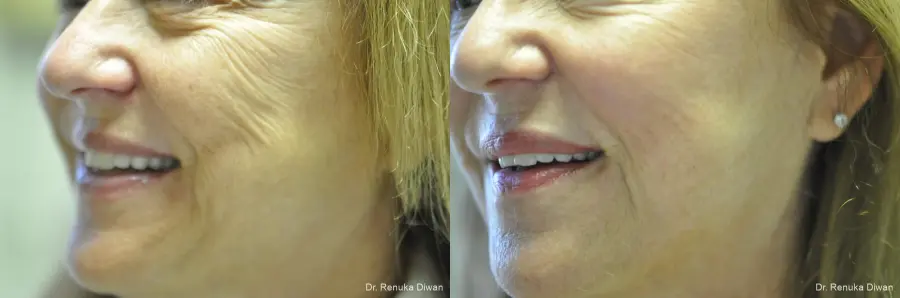 Laser Skin Resurfacing: Patient 11 - Before and After 1