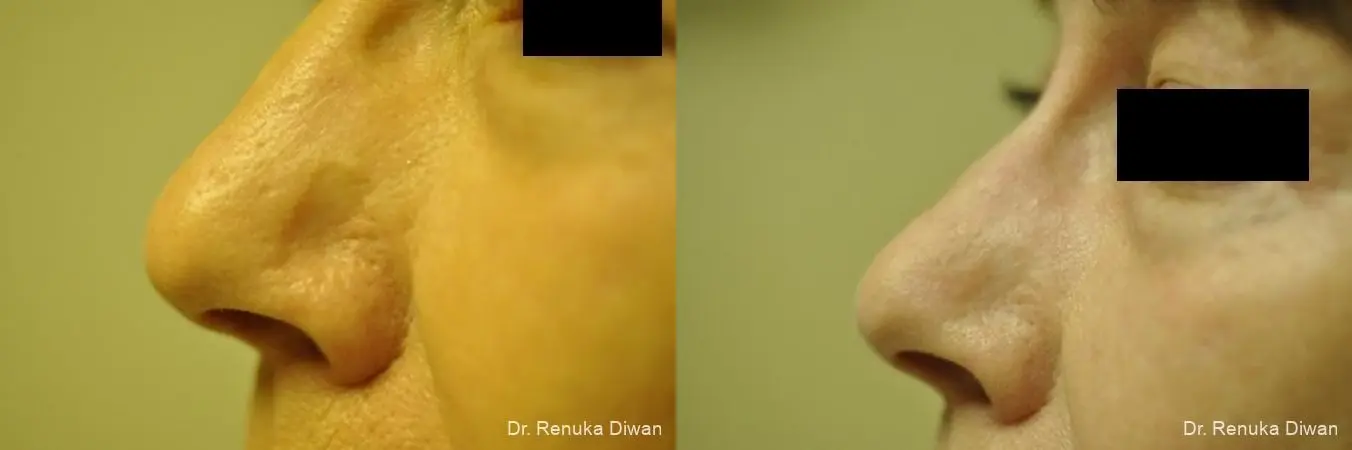 Laser Skin Resurfacing: Patient 14 - Before and After 1