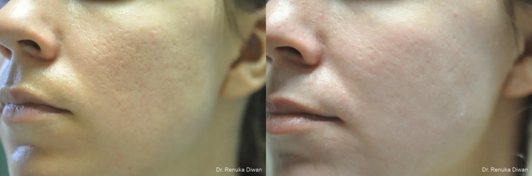 Laser Skin Resurfacing: Patient 12 - Before and After 1