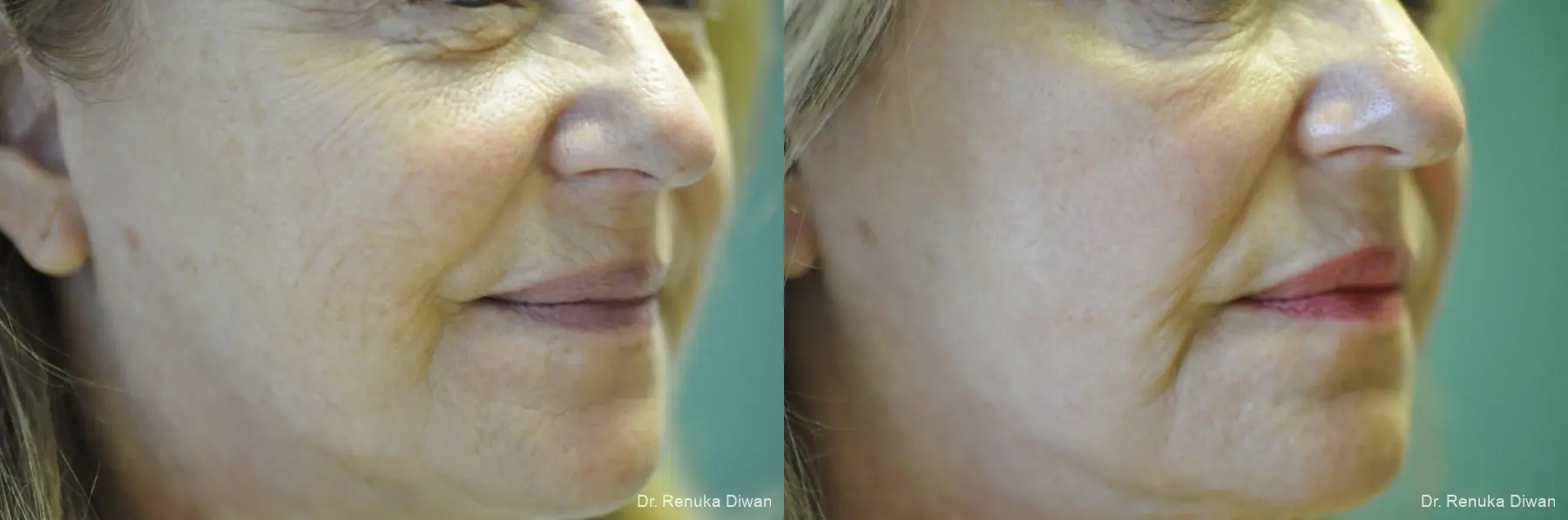 Laser Skin Resurfacing: Patient 11 - Before and After 3