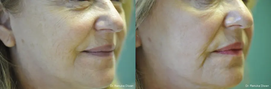 Laser Skin Resurfacing: Patient 11 - Before and After 3