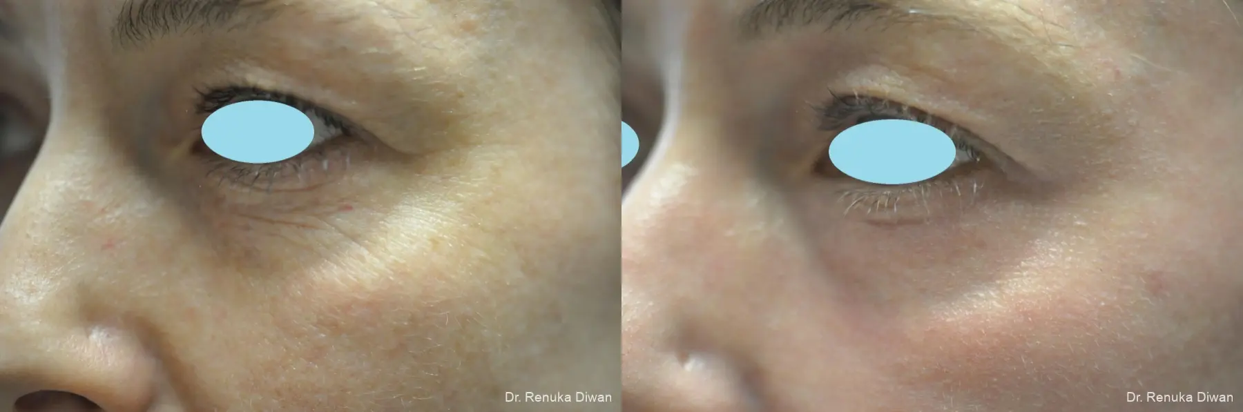 Laser Skin Resurfacing: Patient 16 - Before and After 2