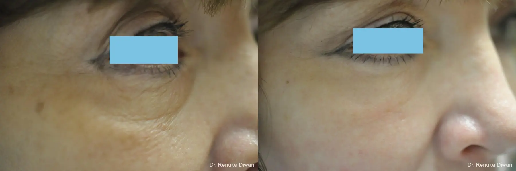Laser Skin Resurfacing: Patient 14 - Before and After 3