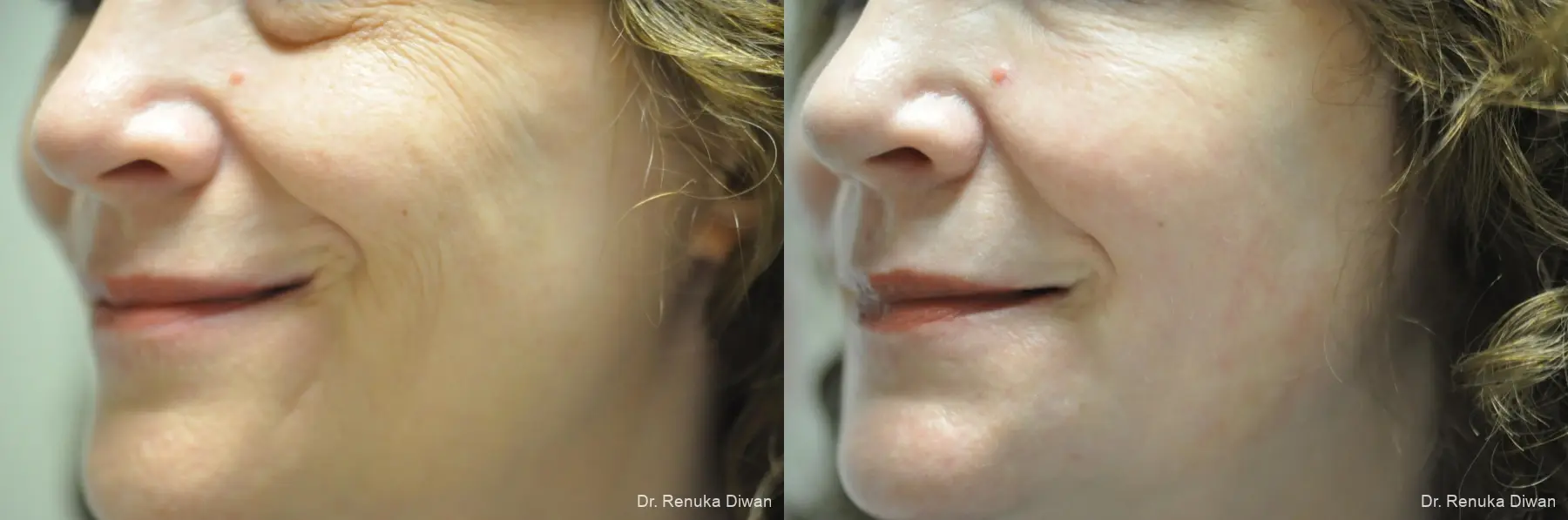 Laser Skin Resurfacing: Patient 14 - Before and After 2