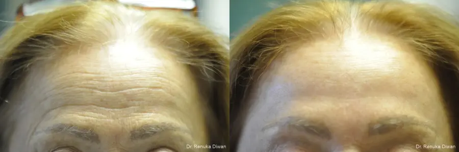 Laser Skin Resurfacing: Patient 11 - Before and After 2