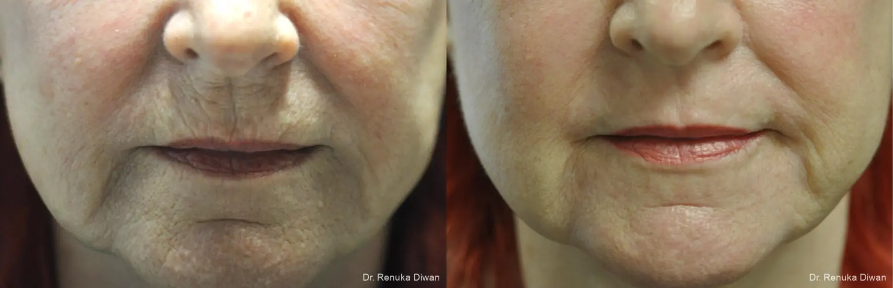 Laser Skin Resurfacing: Patient 18 - Before and After 1