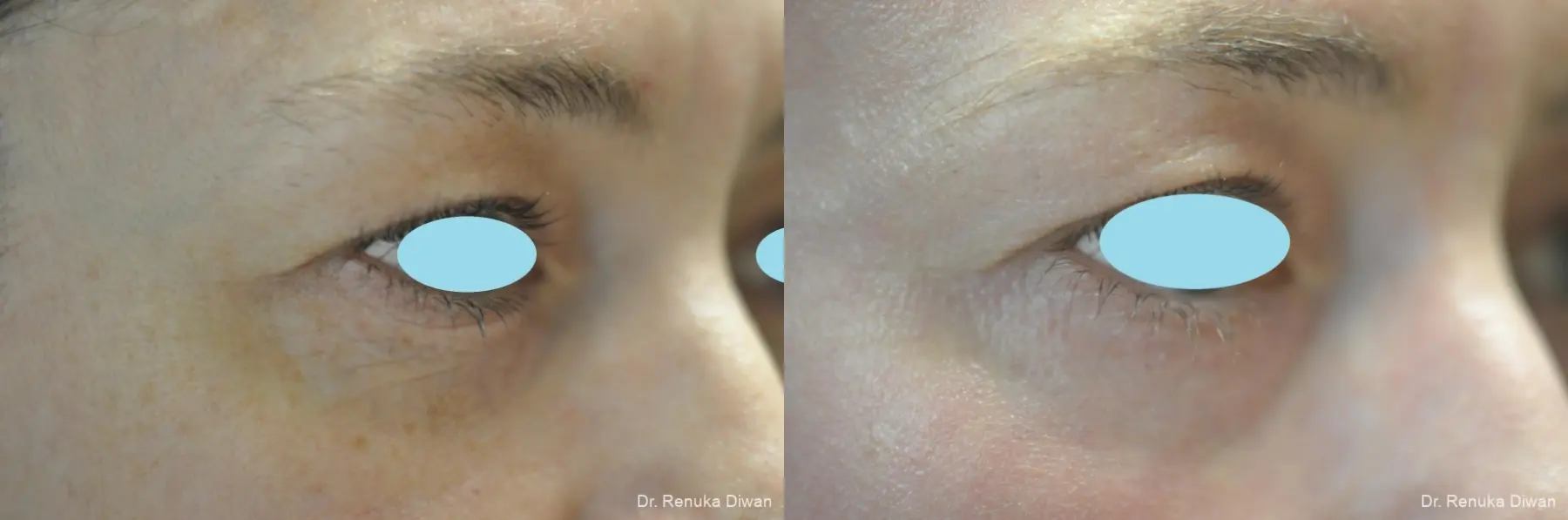Laser Skin Resurfacing: Patient 16 - Before and After 1