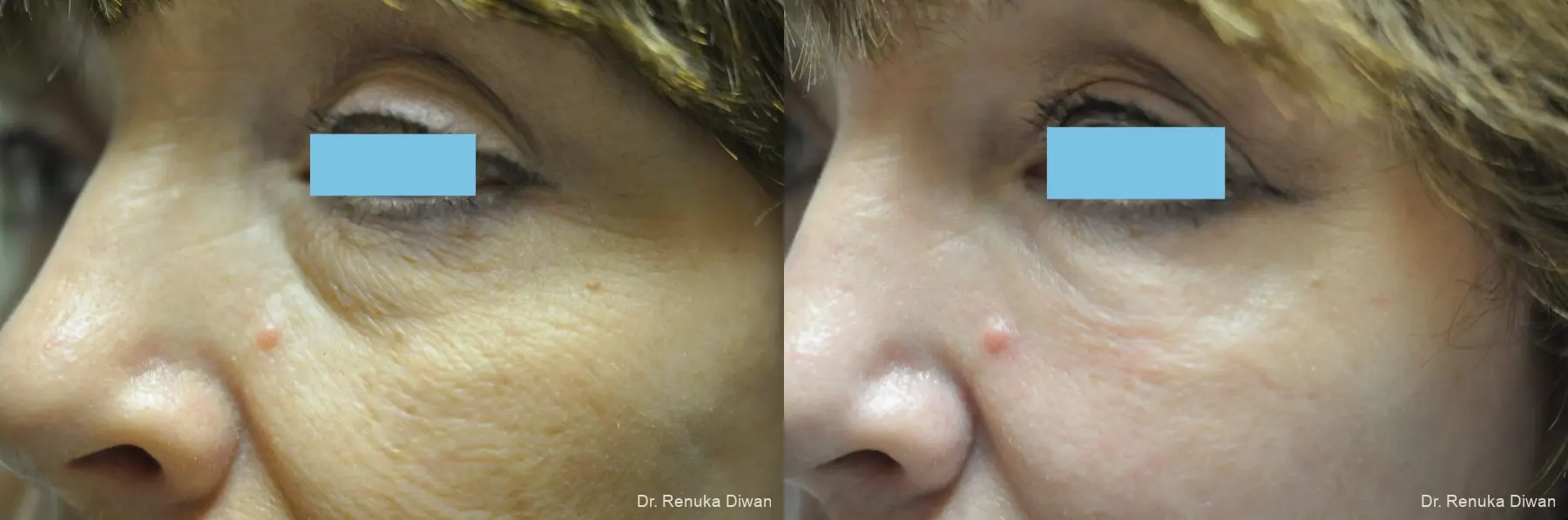 Laser Skin Resurfacing: Patient 14 - Before and After 1