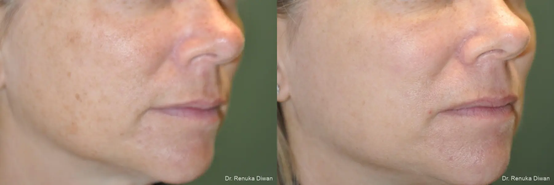 Lasers For Brown Spots: Patient 10 - Before and After 1