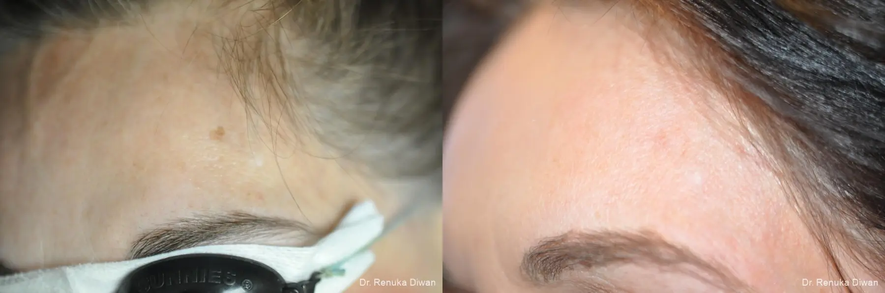 Lasers For Brown Spots: Patient 9 - Before and After 1