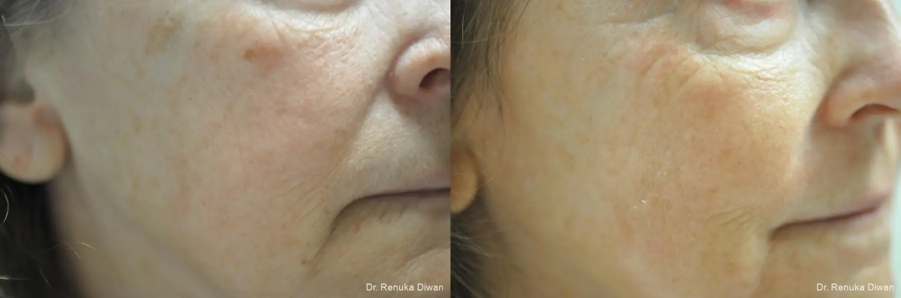 Lasers For Brown Spots: Patient 11 - Before and After 1