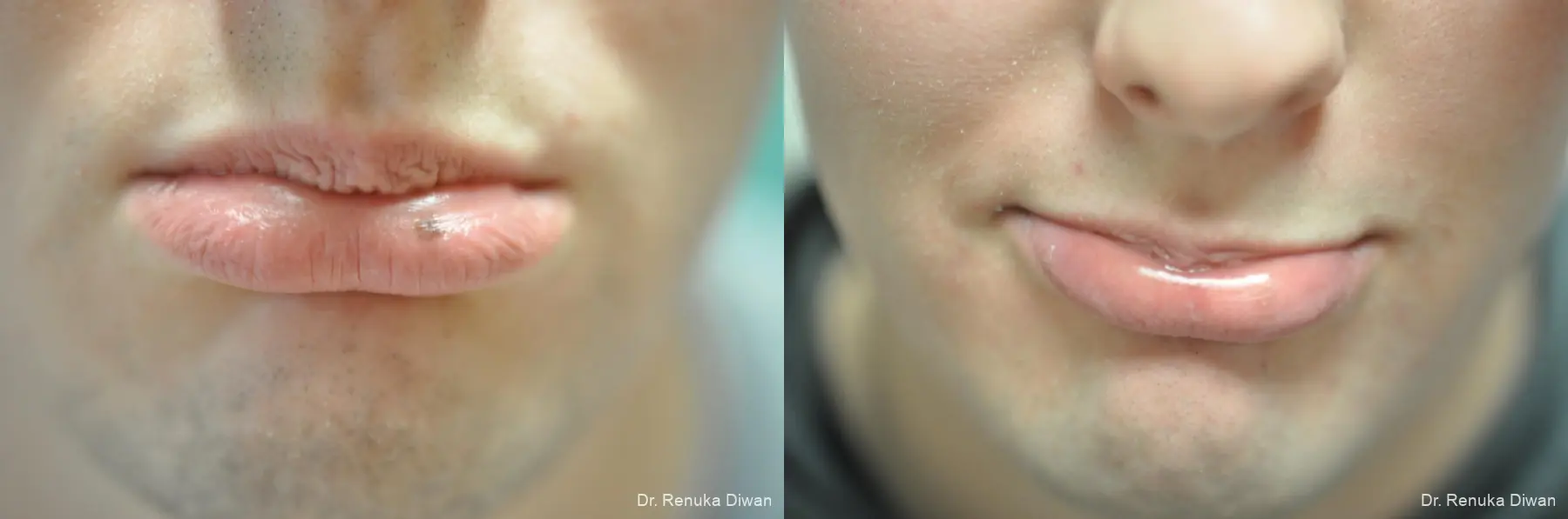 Lasers For Brown Spots: Patient 8 - Before and After  