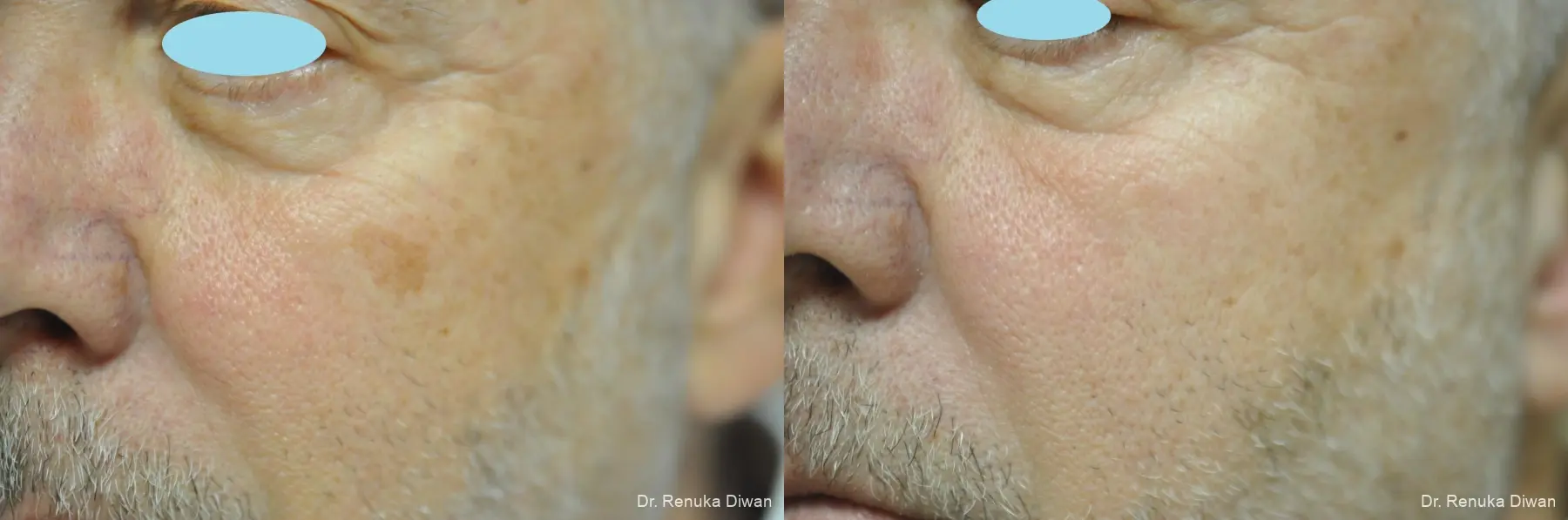Lasers For Brown Spots: Patient 9 - Before and After  