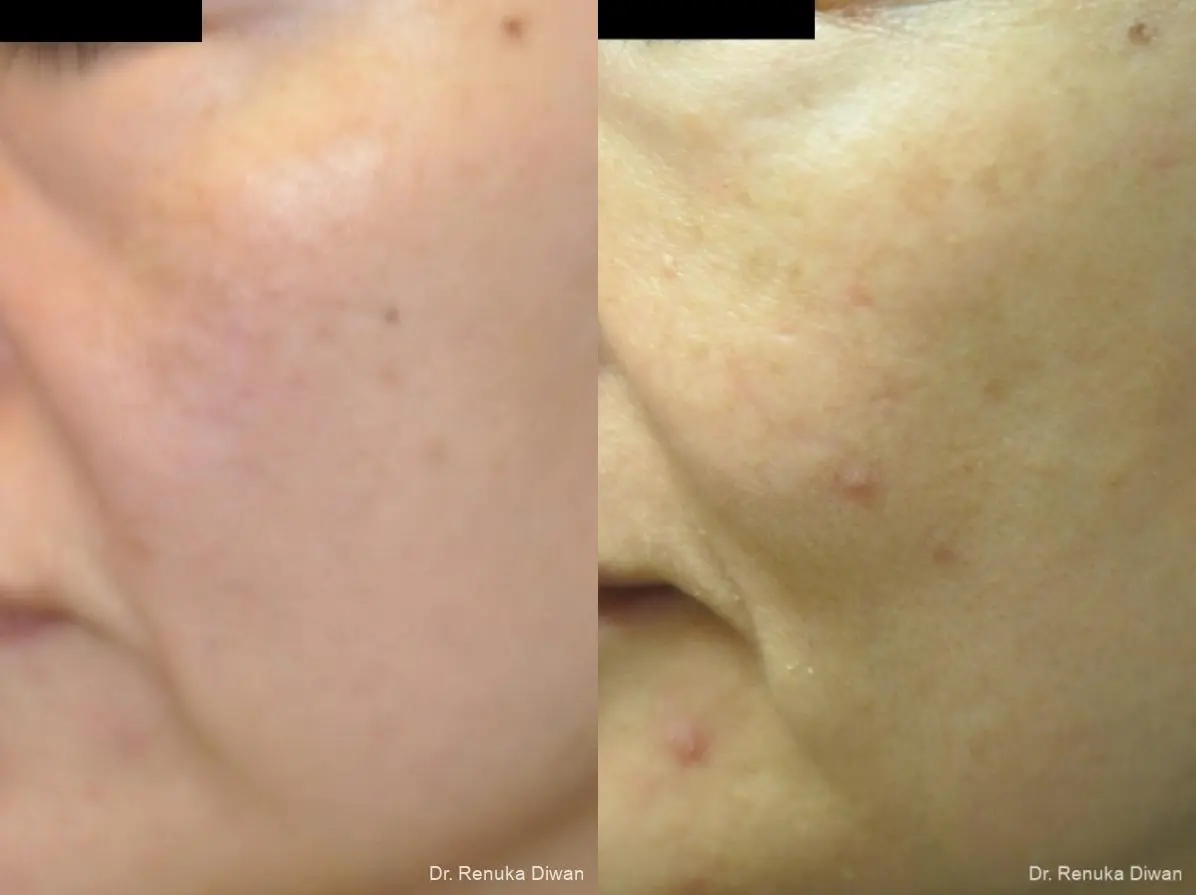 Lasers For Brown Spots: Patient 13 - Before and After 2