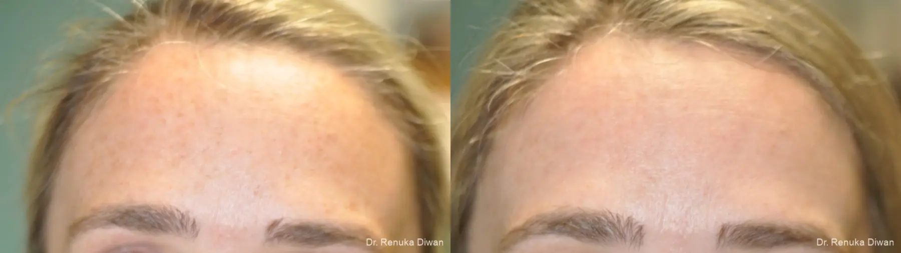 Lasers For Brown Spots: Patient 10 - Before and After 3