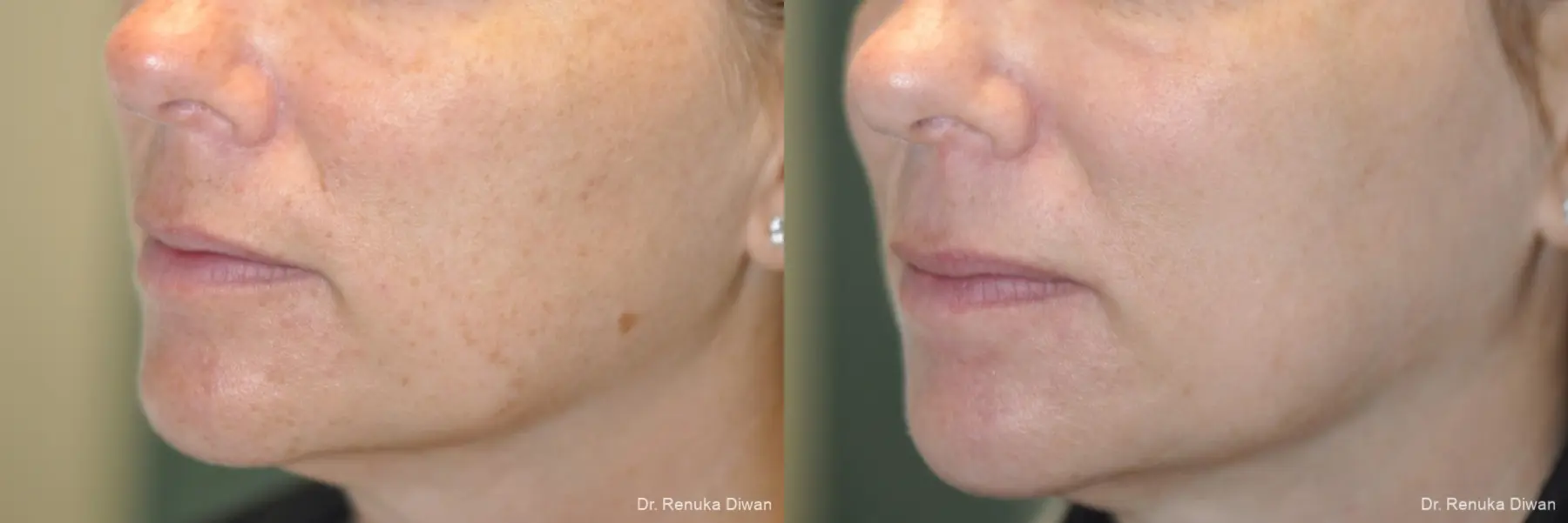 Lasers For Brown Spots: Patient 10 - Before and After 2
