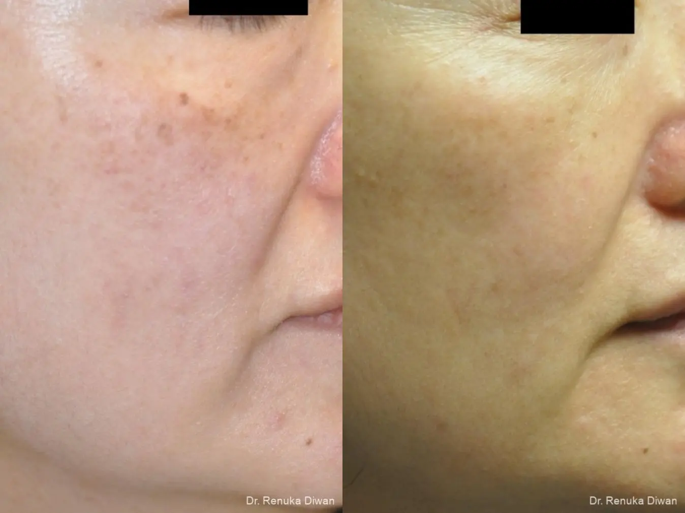 Lasers For Brown Spots: Patient 13 - Before and After 1