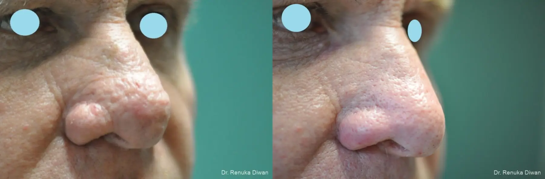 Lasers For Rhinophyma: Patient 5 - Before and After 5