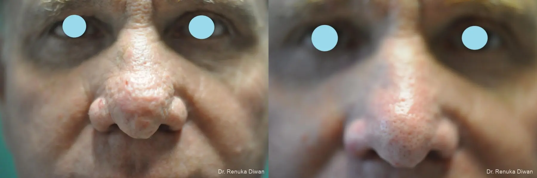 Lasers For Rhinophyma: Patient 5 - Before and After 2