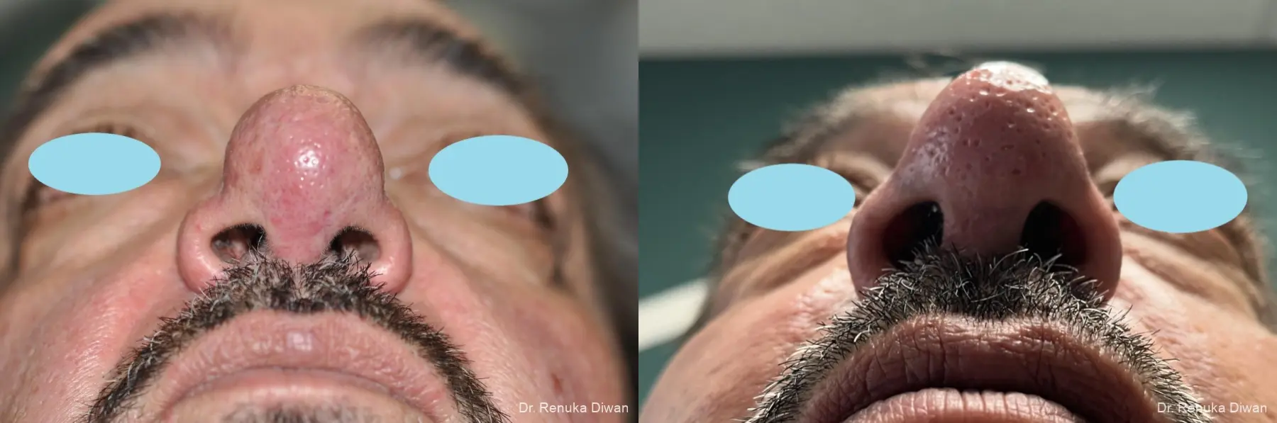 Lasers For Rhinophyma: Patient 4 - Before and After  