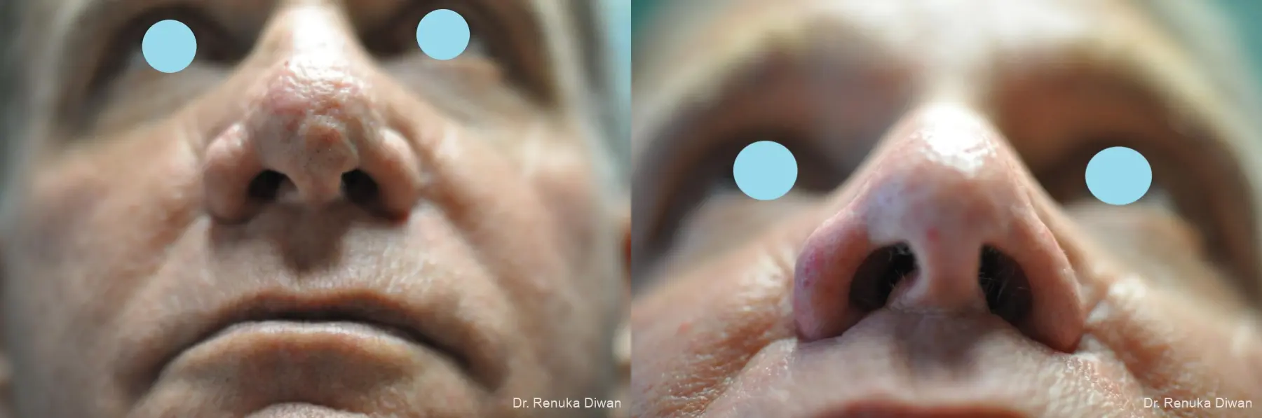 Lasers For Rhinophyma: Patient 5 - Before and After 1