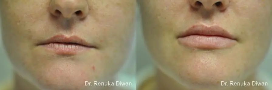 Lip Augmentation: Patient 1 - Before and After  