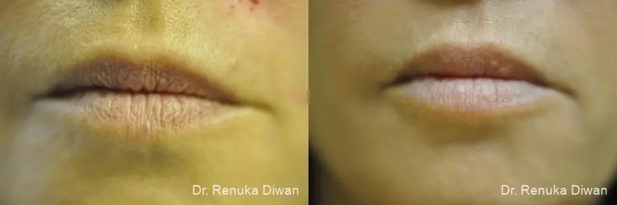 Lip Augmentation: Patient 7 - Before and After  