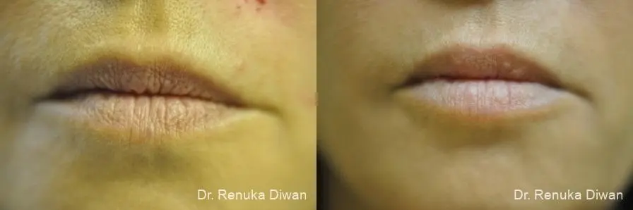 Lip Augmentation: Patient 7 - Before and After 1